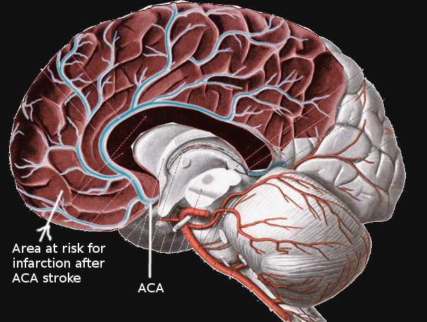 <p>Anterior Cerebral Artery Stroke</p>