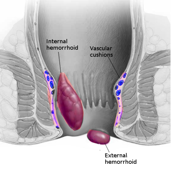 <p>Hemorrhoids. The image shows internal and external hemorrhoids and vascular cushions.</p>