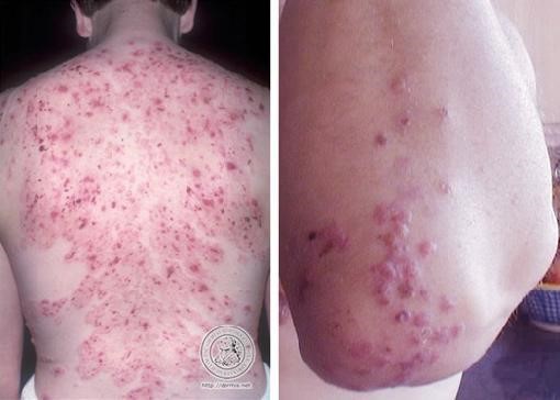 Fig 2: Rash of dermatitis herpetiformis.