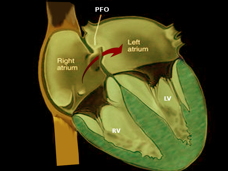 <p>Patent Foramen Ovale (PFO)