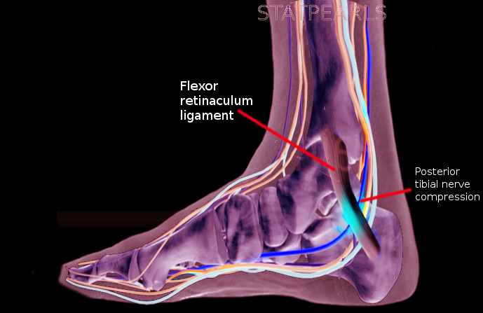 <p>Tarsal Tunnel Syndrome