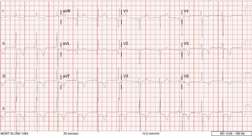 EKG of LM stenosis or critical Aortic Stenosis