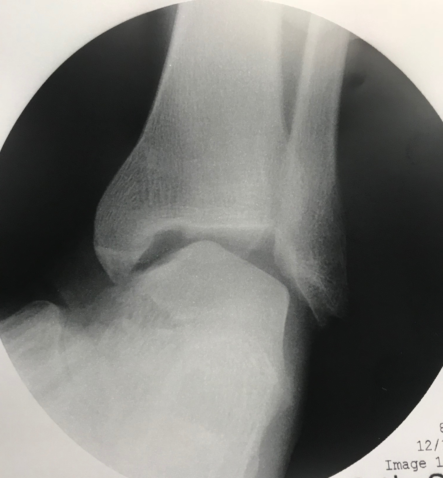 An ankle stress radiograph under live fluoroscopy showing lateral ankle instability with nearly a 40-degree talar tilt angle.
