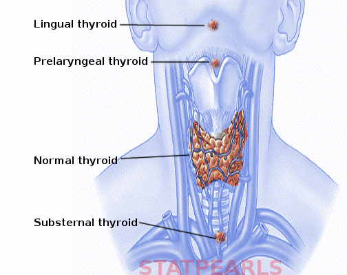<p>Ectopic Thyroid</p>