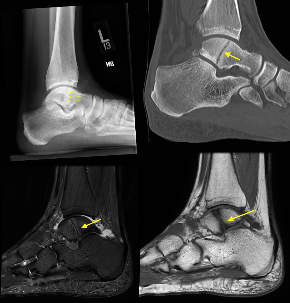 Top left: Lateral radiograph of the ankle shows a subtle lucency through the talar dome and body (arrows), consistent with a non-displaced fracture