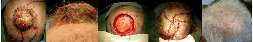 Scalp reconstruction following excision of Merkel cell carcinoma of scalp