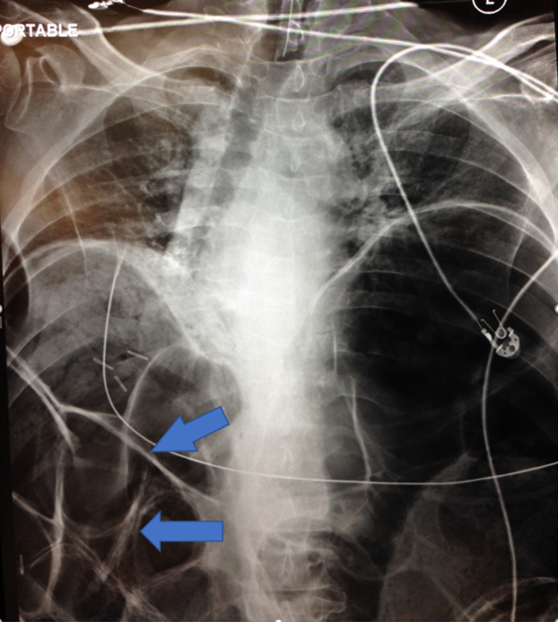 <p>Rigler Sign. Rigler sign and massive free air on chest as seen on radiograph after intubation.&nbsp;&nbsp;</p>