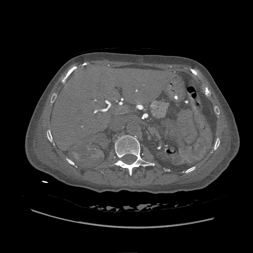 <p>Aortic Thrombosis. Contrasted CT of abdomen.</p>
