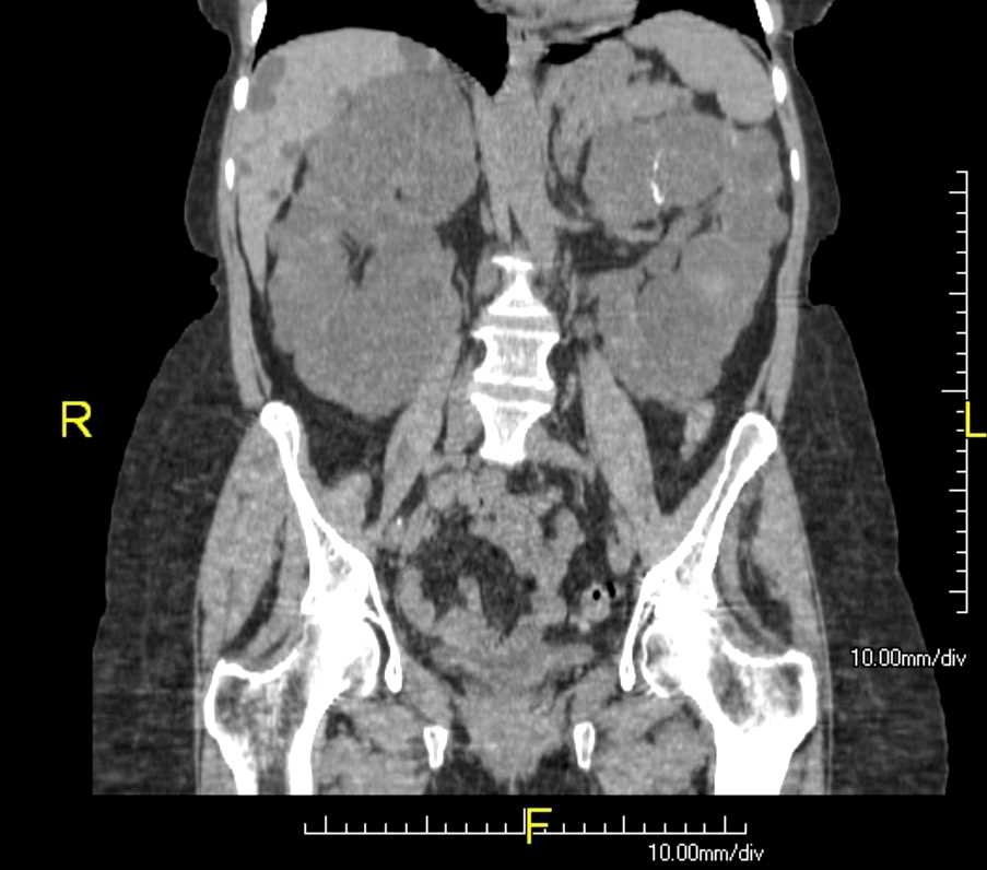 <p>Polycystic Kidneys (ADPKD) and Liver Cysts. CT coronal view of abdomen.</p>