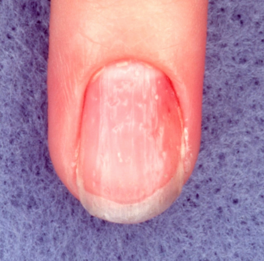<p>Nail Pitting. Nail pitting is commonly seen in patients with psoriasis.</p>