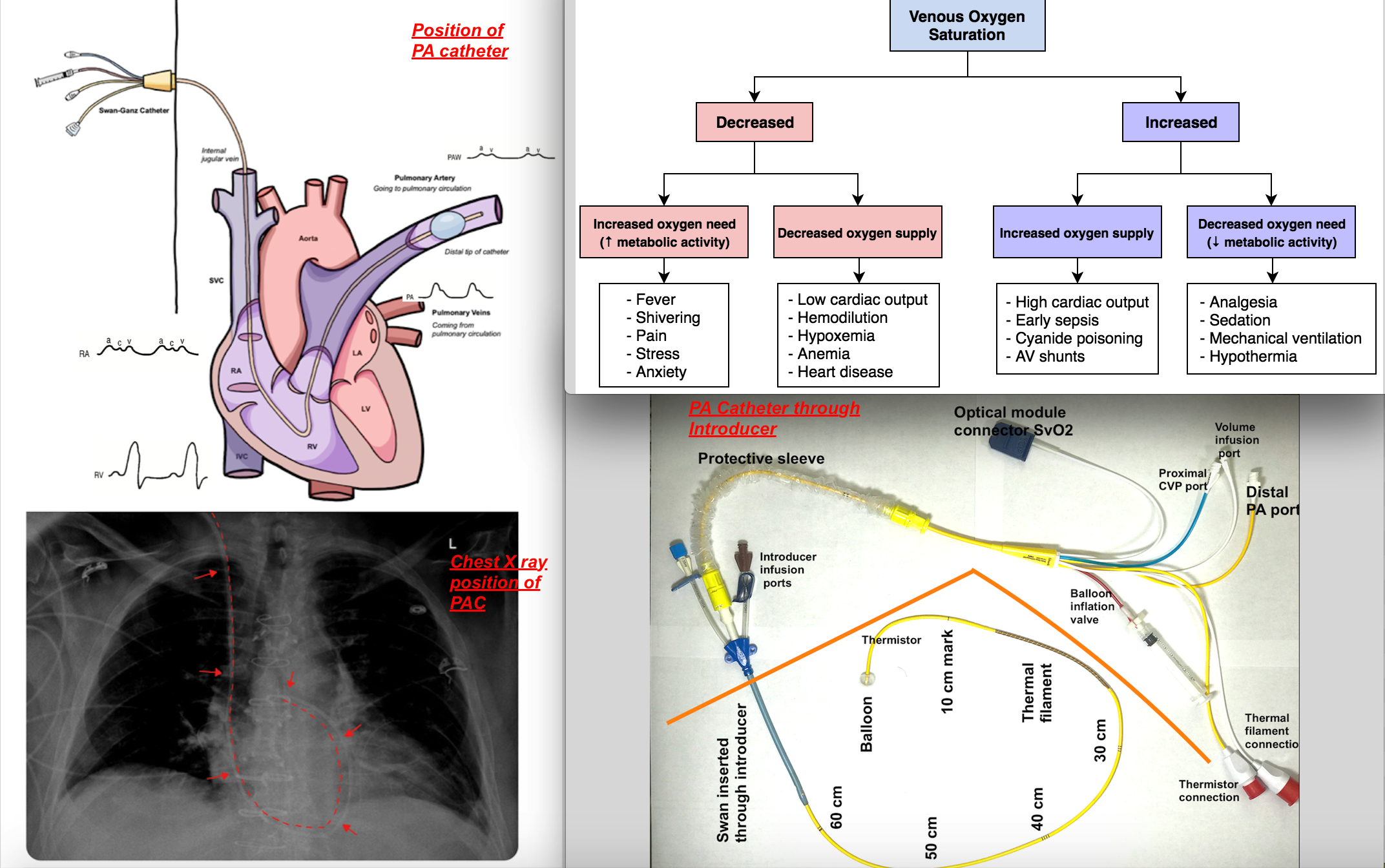 Image depicting position of Pulmonary artery catheter for hemodynamic monitoring, Chest Xray to verify position