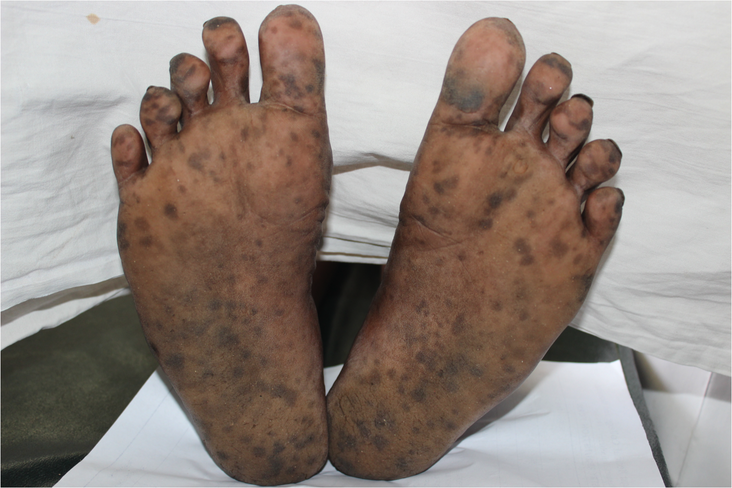 <p>Laugier-Hunziker Syndrome. Multiple well-defined lentiginous macules over plantar aspect of&nbsp;bilateral feet.</p>