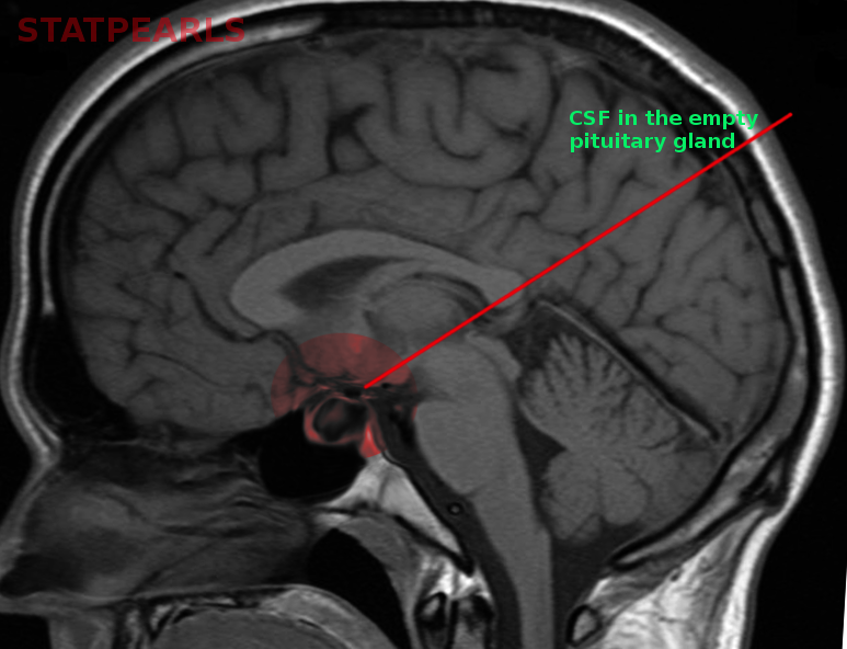 <p>Empty Sella on MRI. Cerebral spinal fluid fills the sella turcica&nbsp;and&nbsp;empty pituitary gland.</p>