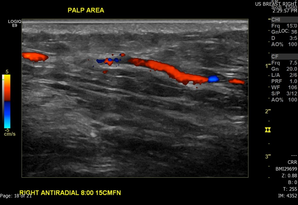 Ultrasound image of the patient's area of palpable concern in the right breast demonstrates a superficial vein with a focal area of absent intraluminal flow on Doppler interrogation