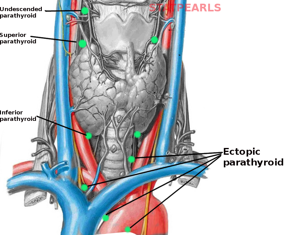 Ectopic parathyroid glands