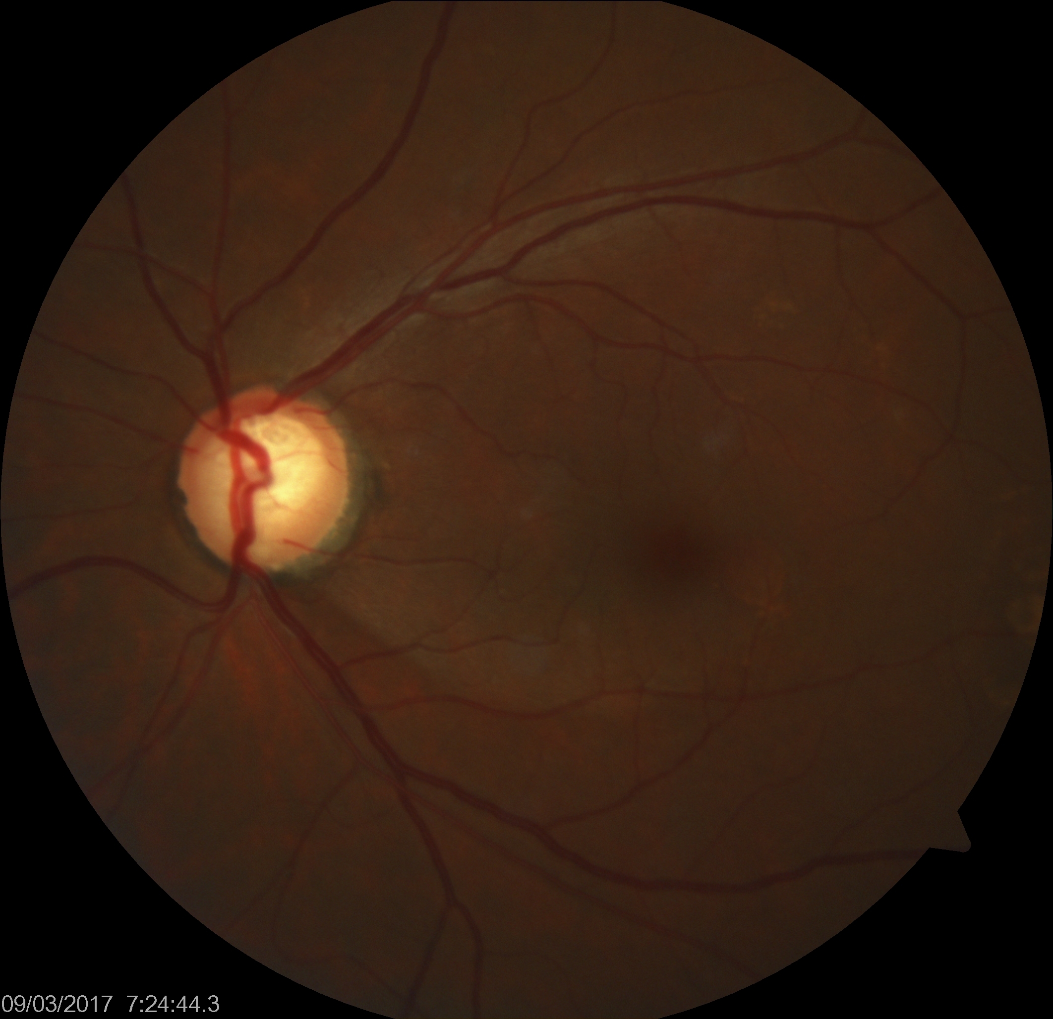 <p>Glaucomatous Optic Nerve Head Showing Inferotemporal Retinal Nerve Fiber Layer Defect