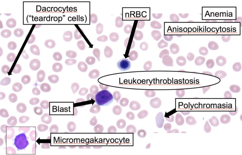 Leukoerythroblastosis reaction in the peripheral smear