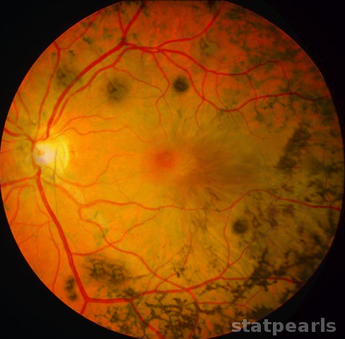 Retinitis Pigmentosa Article