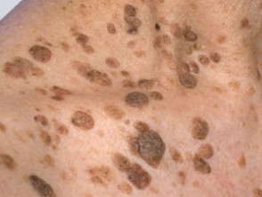 Seborrheic Keratosis Article