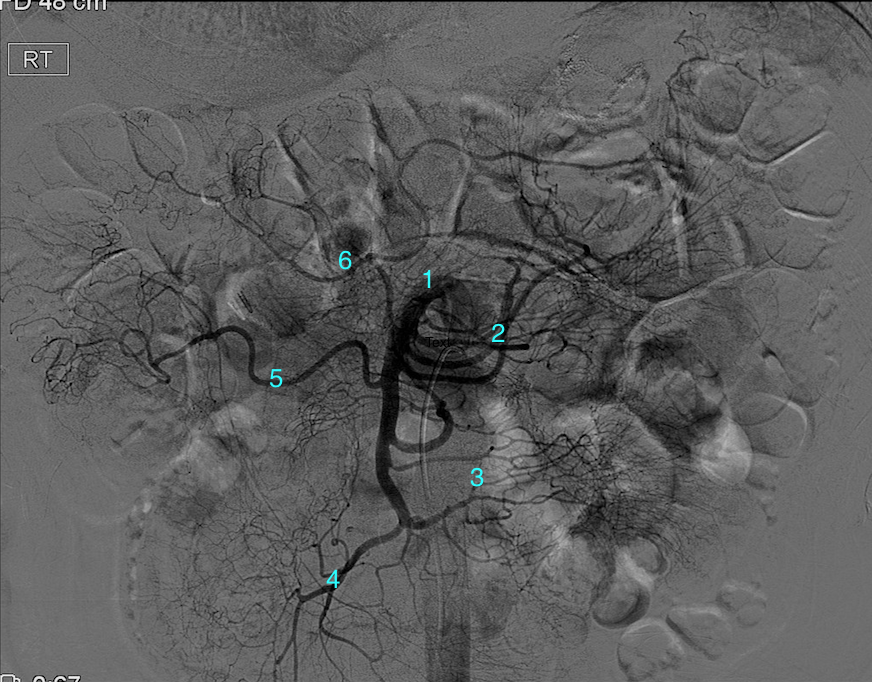 Anatomy Abdomen And Pelvis Ileocolic Artery Article