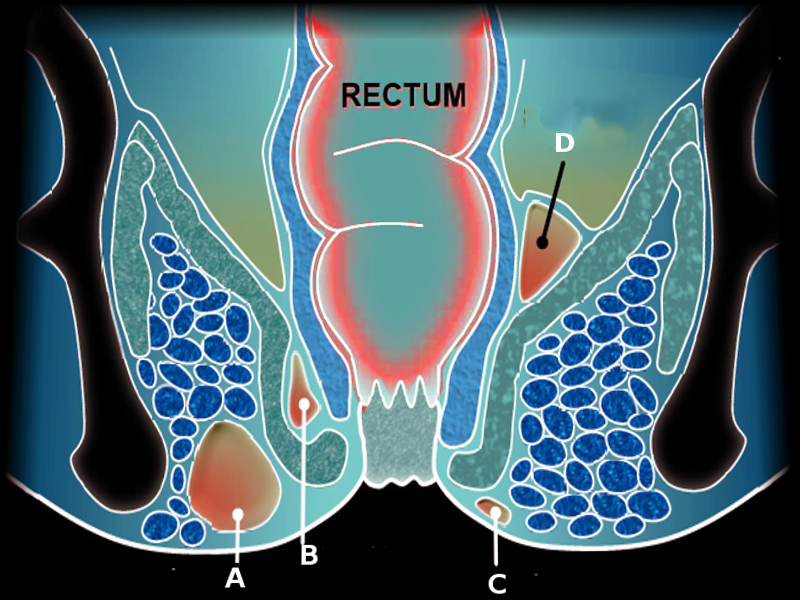 Perirectal Abscess Article 0970