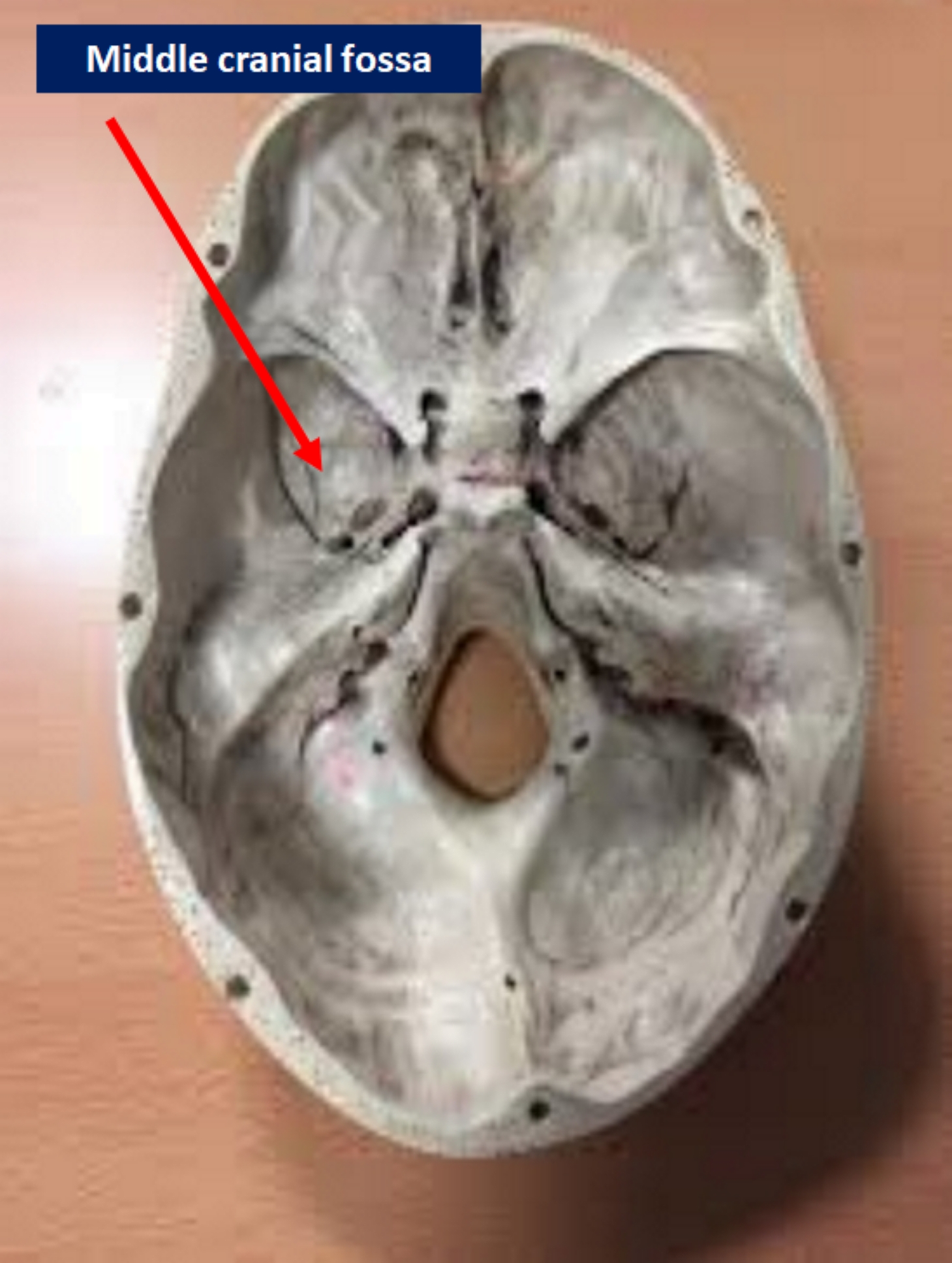 Anatomy, Head and Neck, Middle Cranial Fossa Article - StatPearls