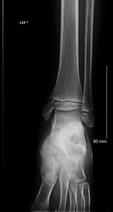 Tibia Fractures Overview Article