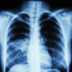 Pneumonia Pathology Article