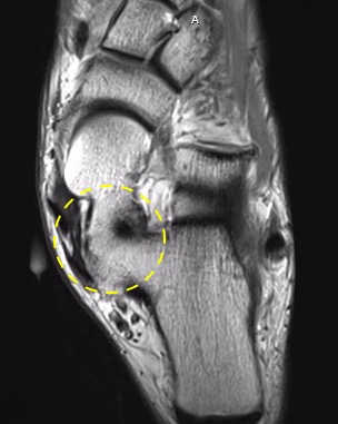 Talocalcaneal Coalition | Treatment & Management | Point of Care