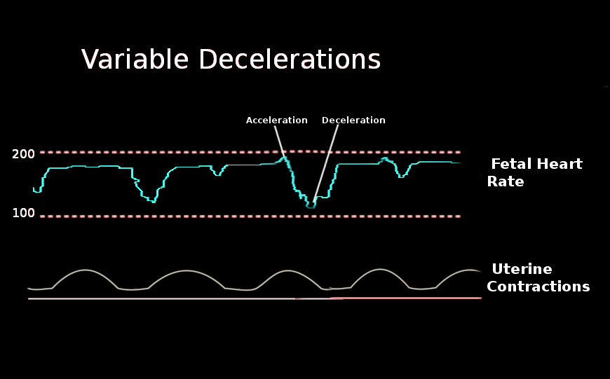 Variable Decelerations Article