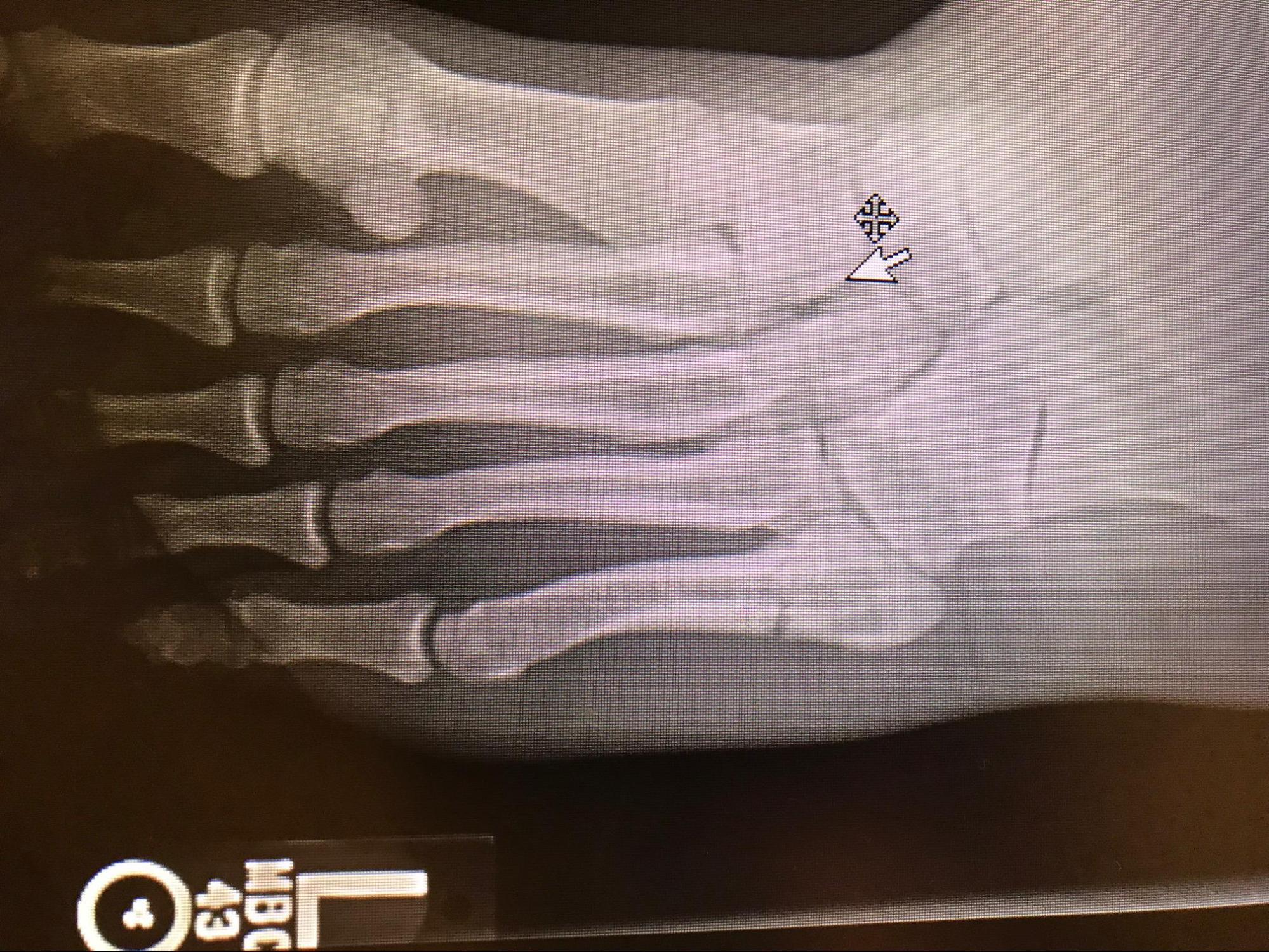 5th Metatarsal Fracture (Jones Fracture, Dancers Fracture) Article ...