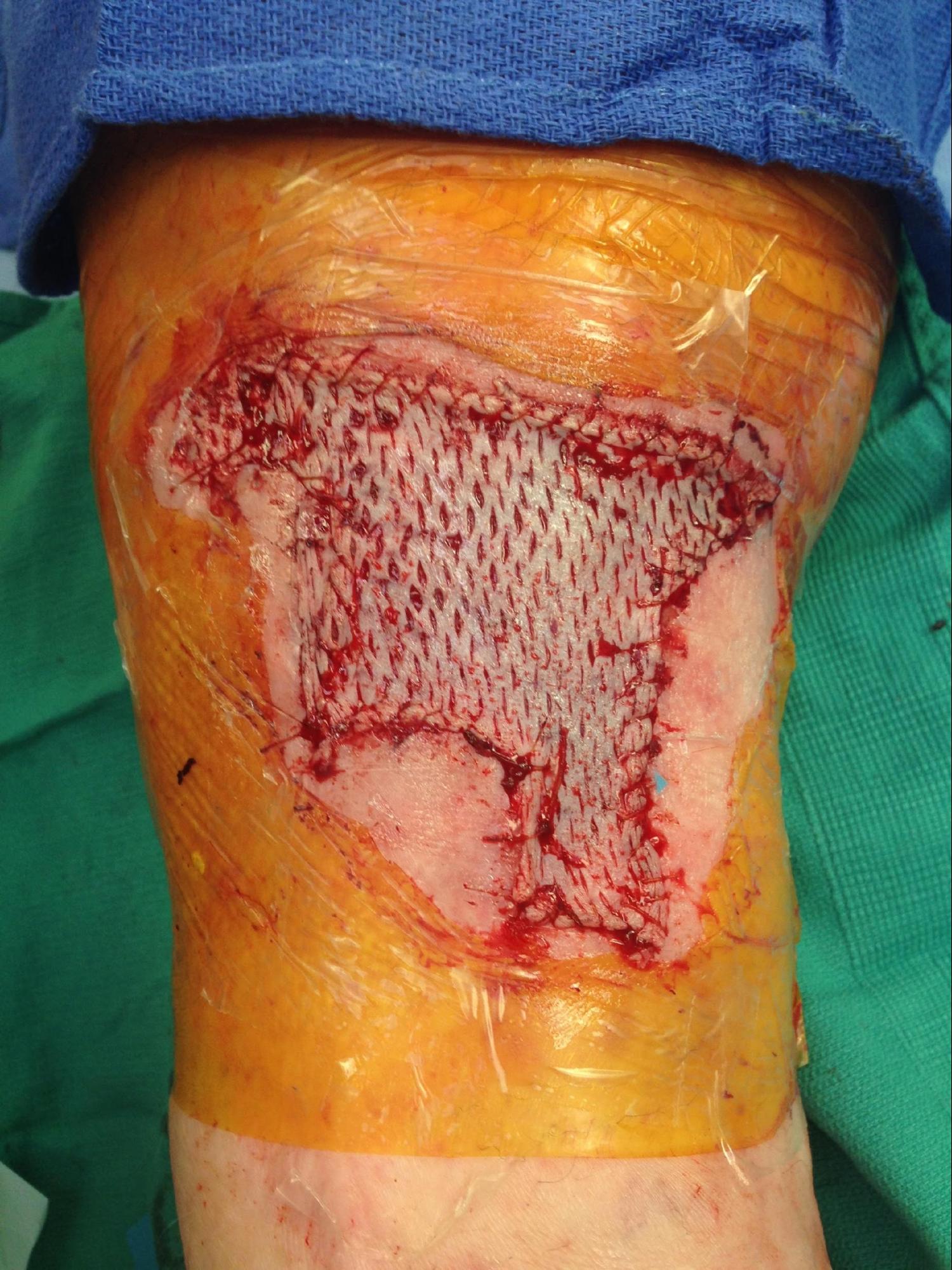 Skin Grafting Article