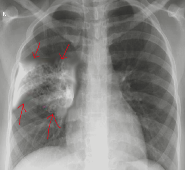 Pneumonia Pathology Article