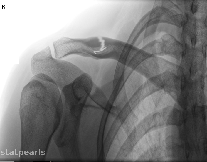 Clavicle Fractures | Treatment & Management | Point of Care