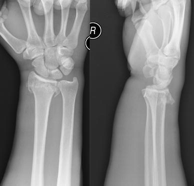 Smith Fracture Garden Spade Deformity | Fasci Garden