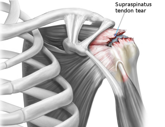 Rotator Cuff Injury | Treatment & Management | Point of Care