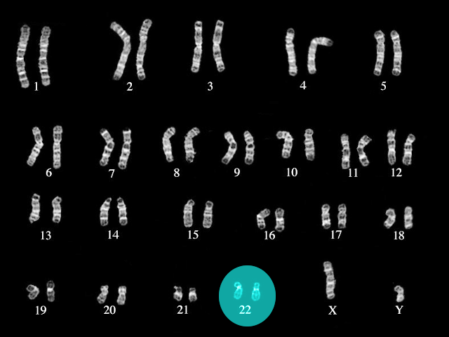 DiGeorge Syndrome Article