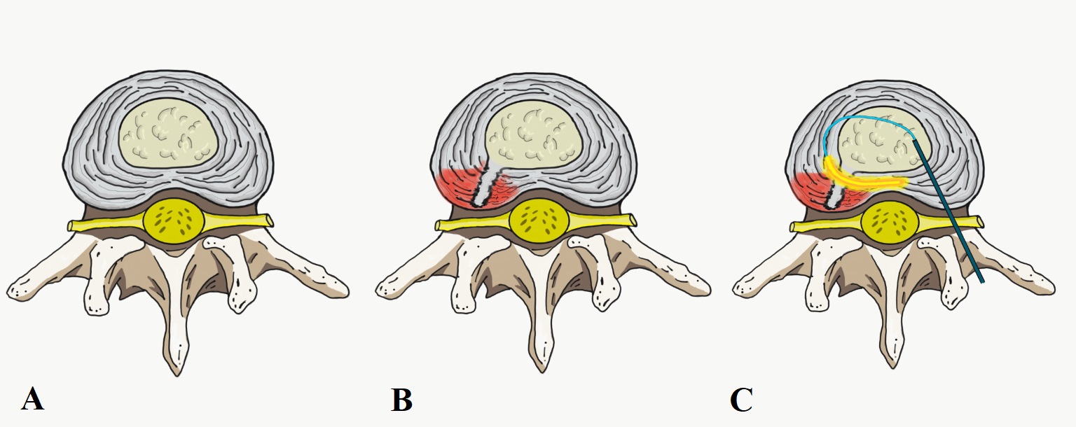 Intradiscal Electrothermal Therapy Article