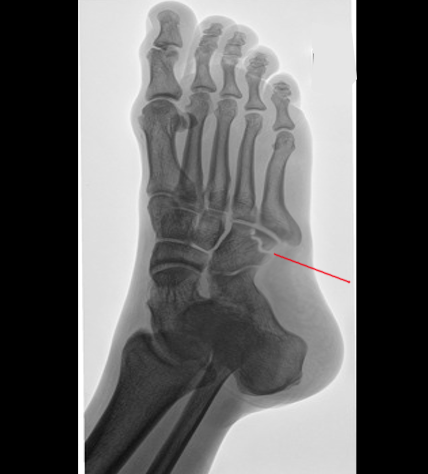 Anatomy, Bony Pelvis and Lower Limb, Foot Cuboid Bone Article