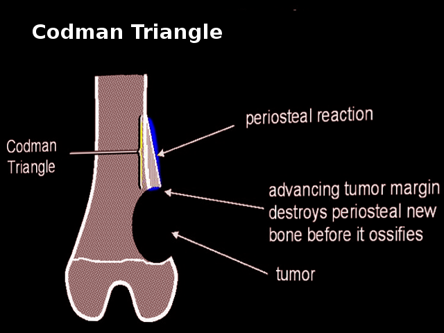 Codman Triangle Article