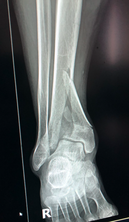 Pilon Fracture | Treatment & Management | Point Of Care