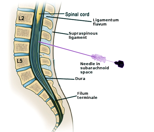 Saddle Anesthetic Block | Treatment & Management | Point of Care