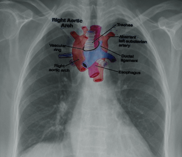 Embryology, Aortic Arch Article