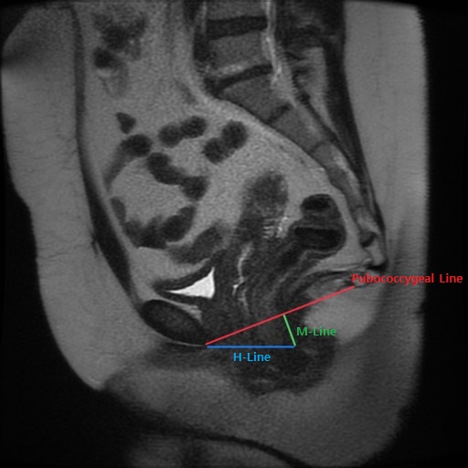 Pelvic Prolapse Imaging Article