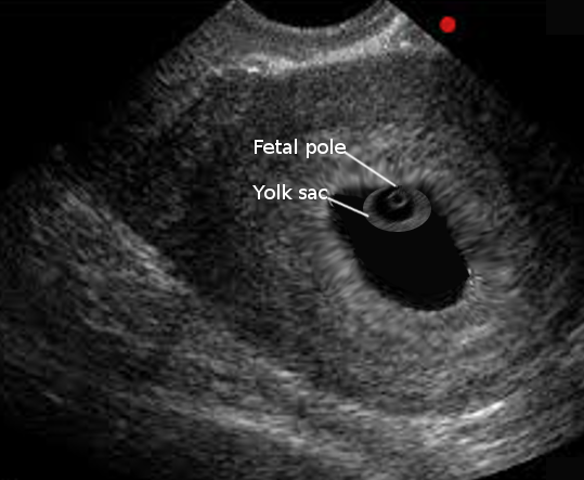 gestational-sac-evaluation-article