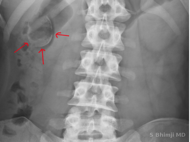 Porcelain Gallbladder Article