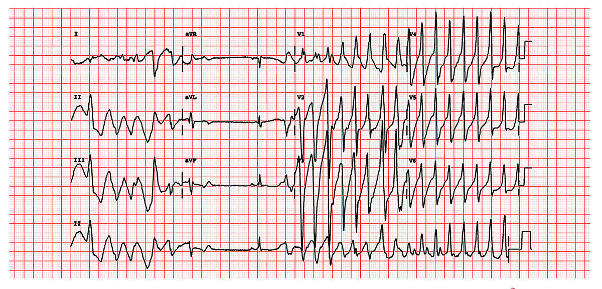 Torsade de Pointes Article