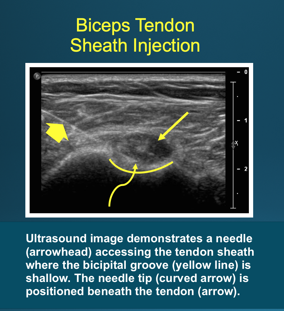 Biceps Tendon Injection