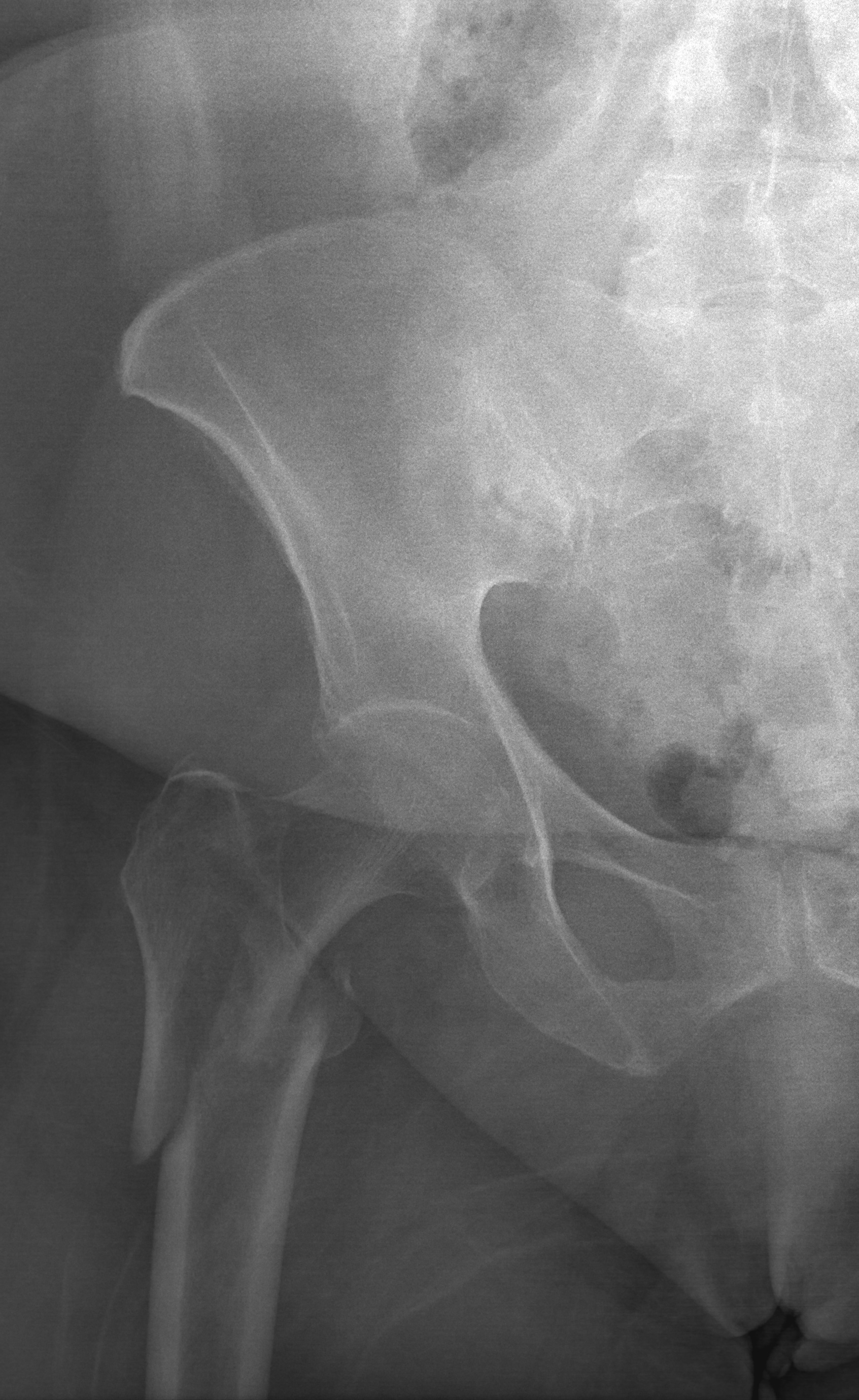 Intertrochanteric Femur Fracture | Treatment & Management | Point of Care