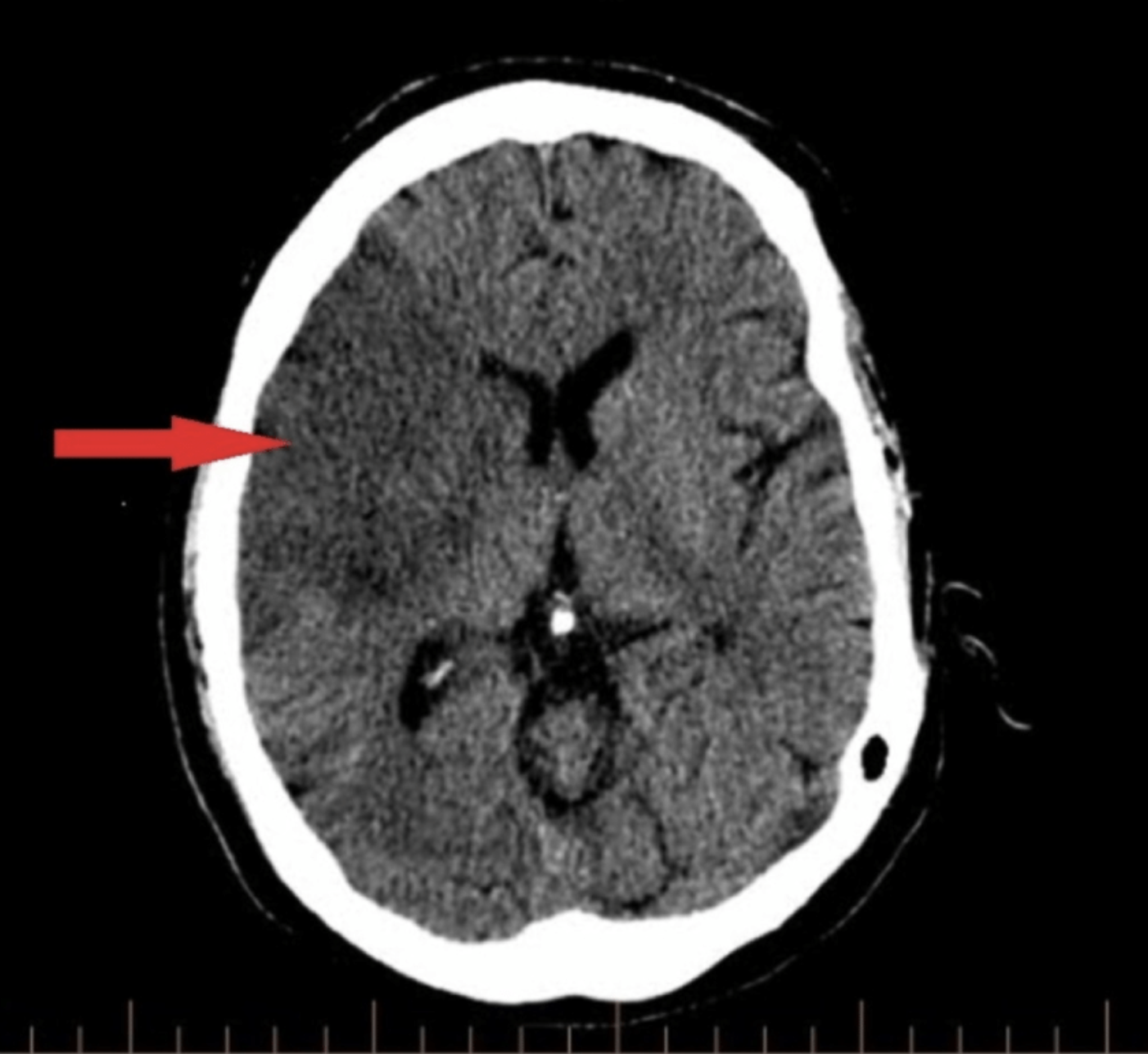 Middle Cerebral Artery Stroke Article